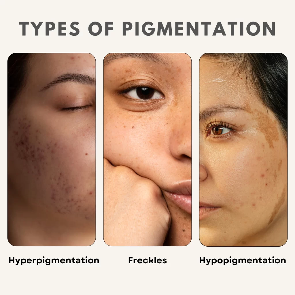 Types of Skin Pigmentation​