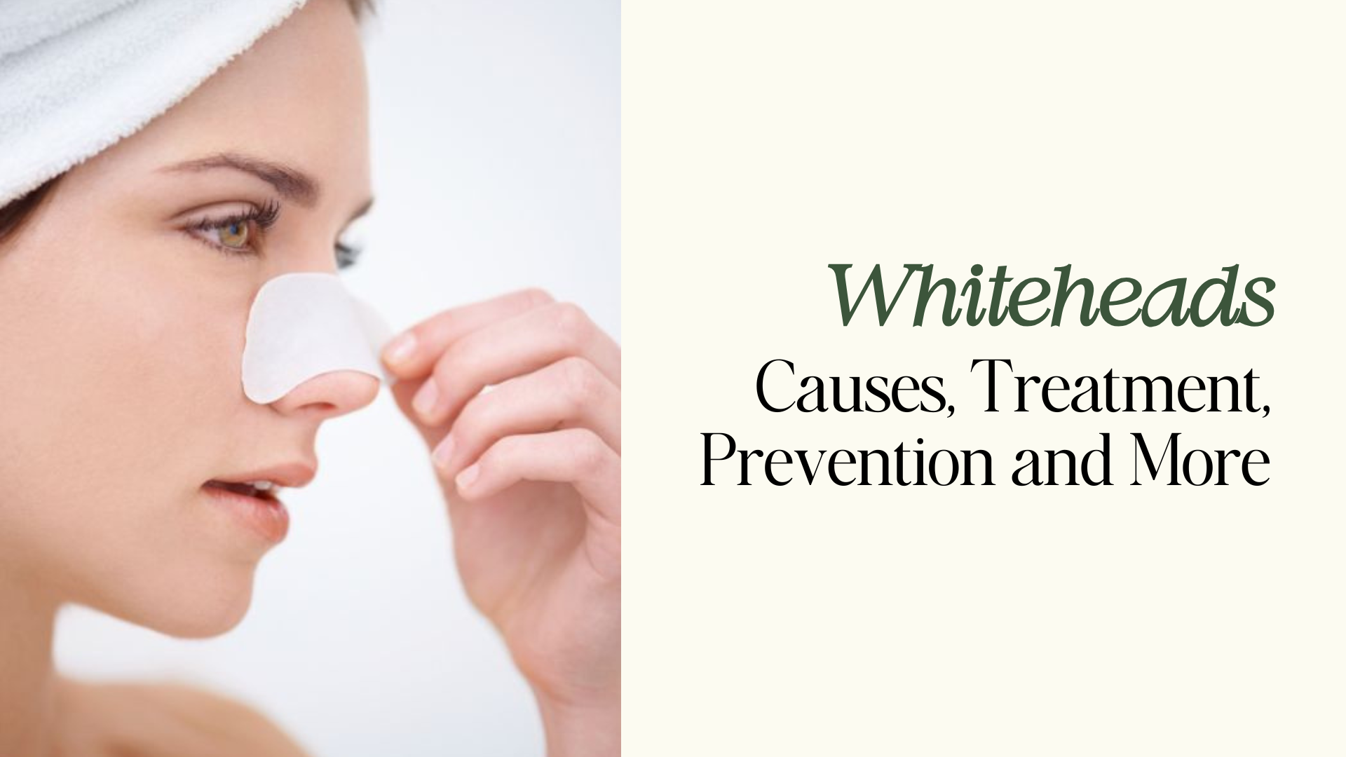 Whiteheads – Causes, Treatment, Prevention and More