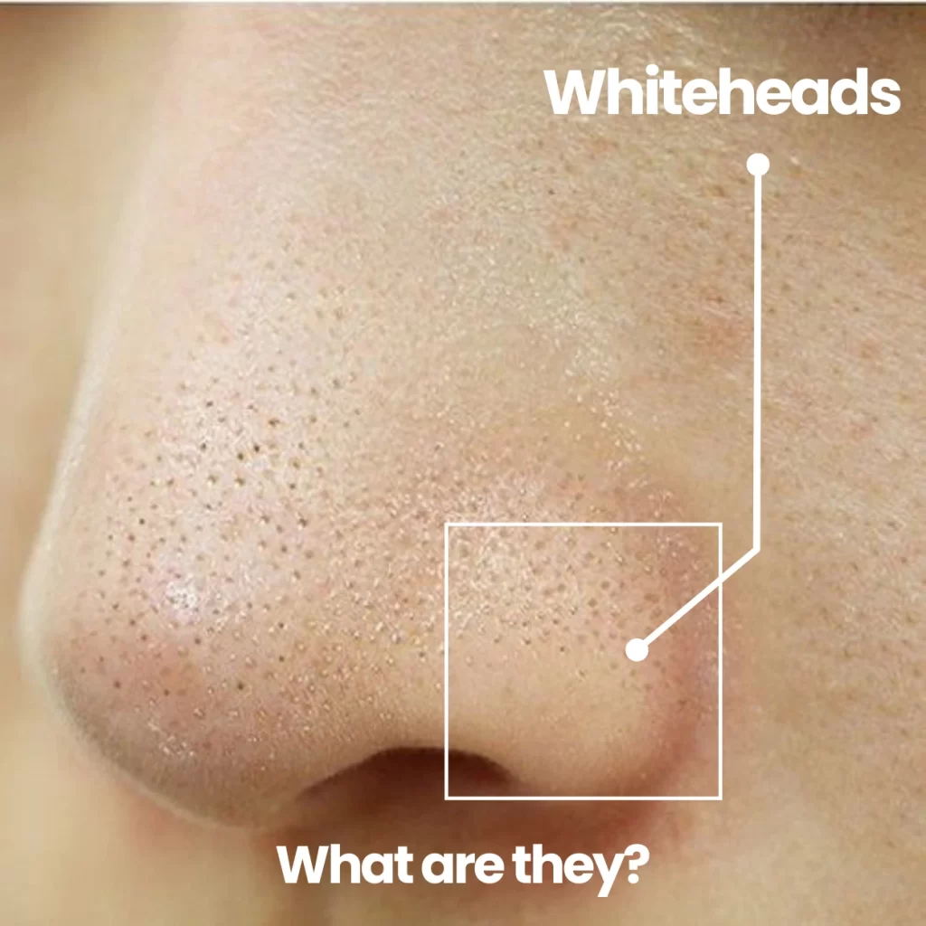 whiteheads