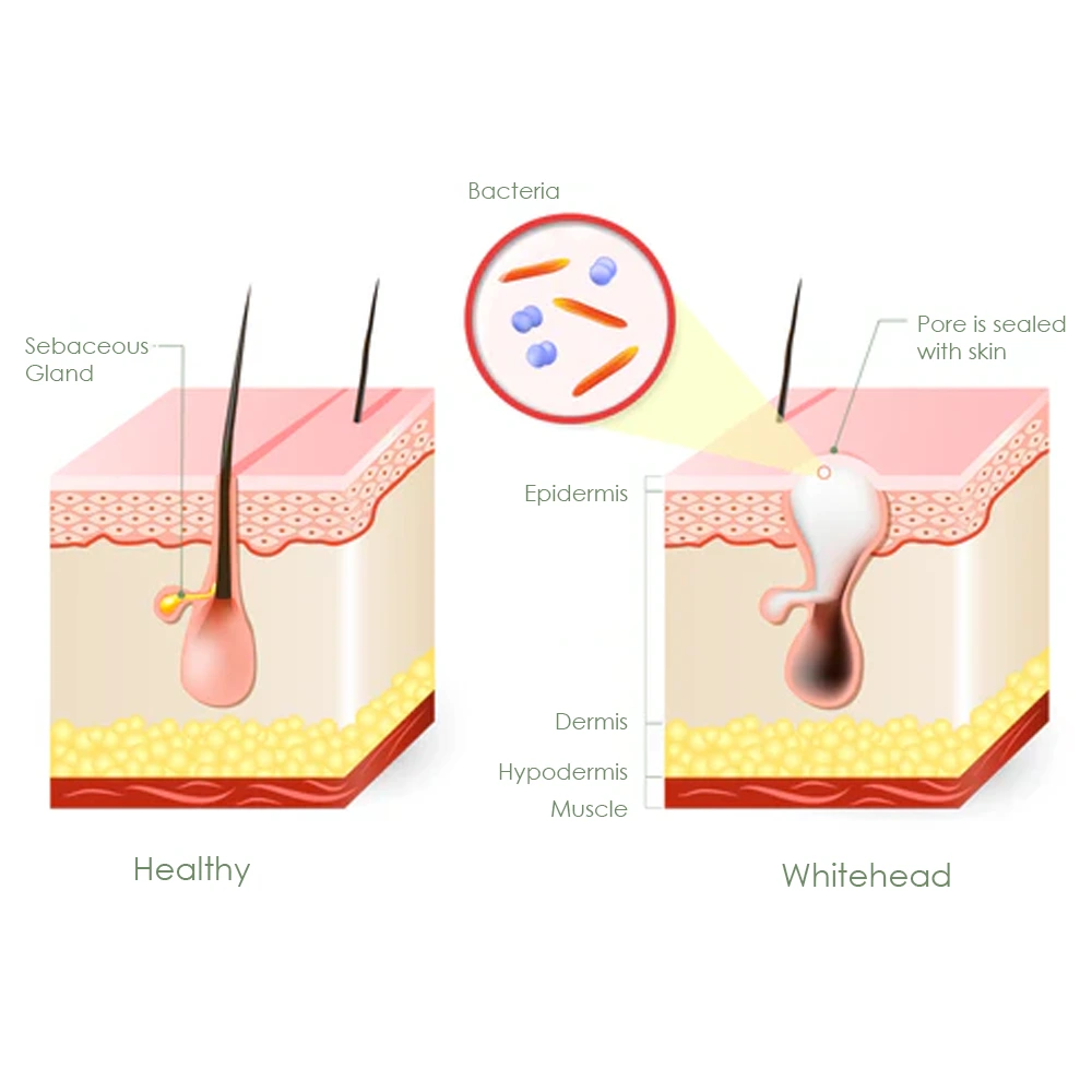 whiteheads info