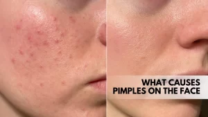 What causes pimples on the face