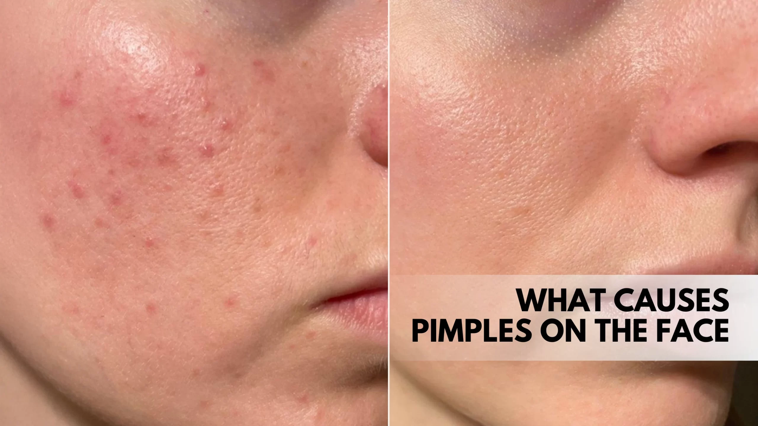 What causes pimples on the face