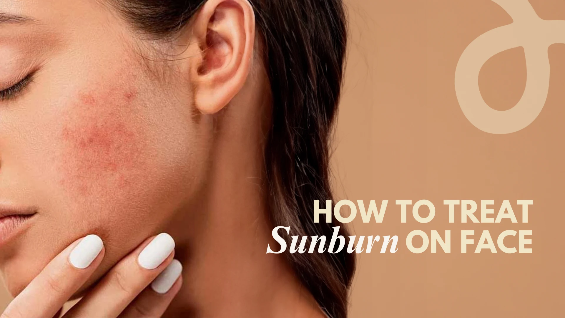 How to Treat Sunburn on Face