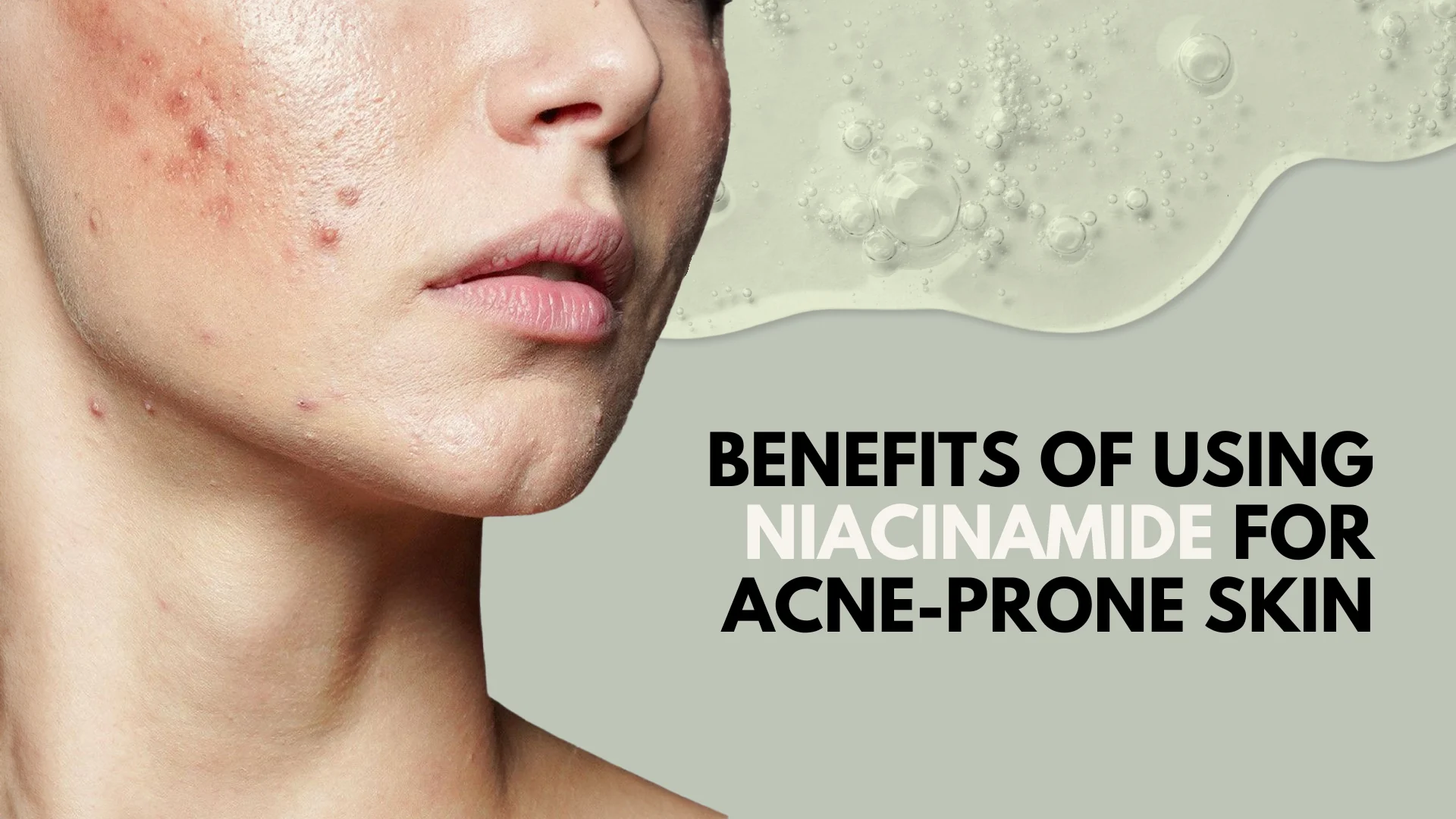Benefits Of Niacinamide For Acne Prone Skin